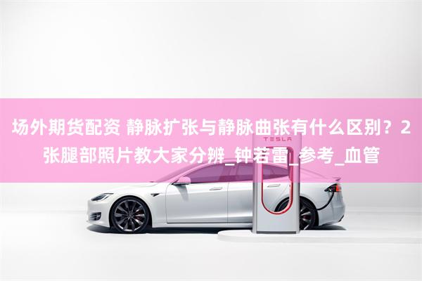 场外期货配资 静脉扩张与静脉曲张有什么区别？2张腿部照片教大家分辨_钟若雷_参考_血管